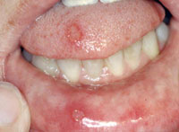 Munnskåld kan være svært smertefullt