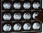 MR-bilder fra pasienter