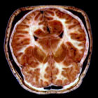 Måling av det magnetiske feltet i hjernen. Foto: BBC