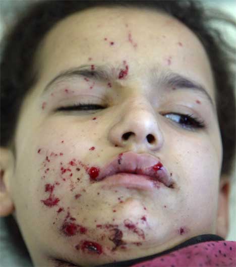 12-rige Sara ble skutt i hnden og i beinet etter at det amerikanske kjretyet eksploderte. (Foto: Scanpix / Reuters / Faleh Kheiber)