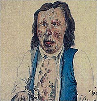 Olof Andersson fr Sogndal var ein av dei mange som vart rka av den fryktelege sjukdomen. (Akvarell fr St. Jrgens hospital)