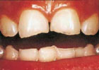 Tennene blir kortere av syre