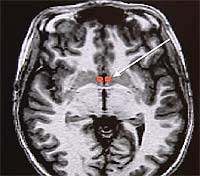 Tverrsnitt av hjernen - med forelskelsessenteret (Grafikk: Inge Rasmussen, St. Olavs hospital)