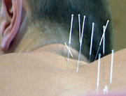 Akupunktur en en av flere alternative behandlingsformer. Foto: NRK.