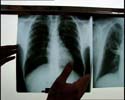 Ved mistanke om tuberkolosesmitte undersøkes lungene med røntgen (Arkivfoto).