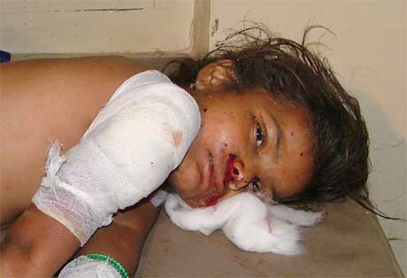 Denne vesle jenta var ei av over 60 skadde i eksplosjonane i Varanasi. Minst 15 miste livet. (Foto: AP/Scanpix)
