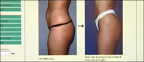 Før- og etterbilde på fettsuging, tatt fra internett. Foto: NRK, Anders Leines